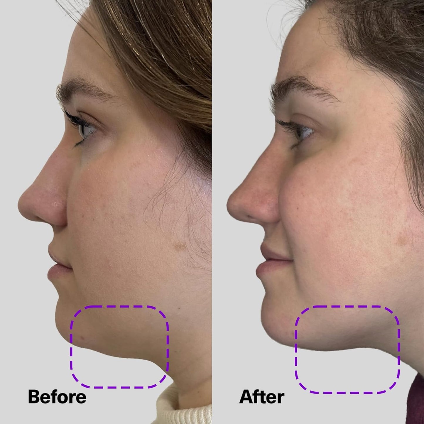 SickScience* ShapeShift Advanced Jaw & Neck Firming Serum - Double Chin Reducer